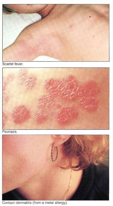 Different Types Different Types Rashes