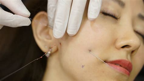 Review Of Face Thread Lifting In The Clifford Clinic