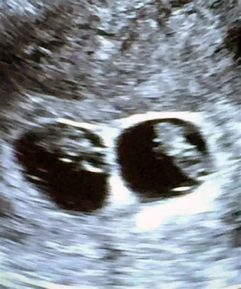 9 Weeks Pregnant With Twins Ultrasound Symptoms Physical Acticity