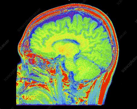 Mri Of Normal Brain Stock Image C0094719 Science Photo Library