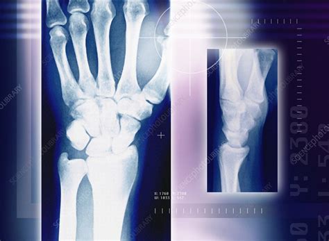 Wrist Bones X Ray Stock Image P1160546 Science