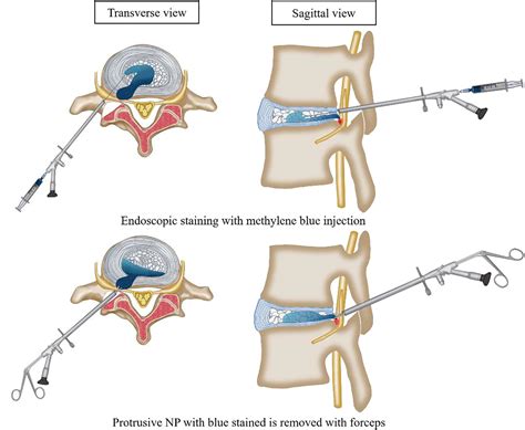 Percutaneous Endoscopic Lumbar Discectomy For Lumbar Disc Herniation