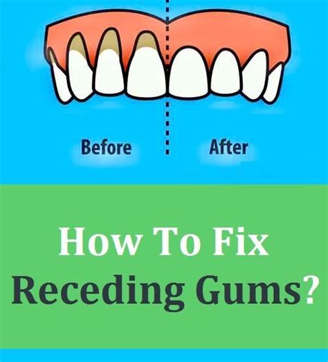 Because the gums play such an important role in receding gums are a common dental issue but can be a relatively early sign of gum disease. How To Fix Receding Gums? | Receding gums, Gum recession ...