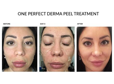 The Perfect Derma Peel In St Petersburg Clearwater And The Tampa Bay