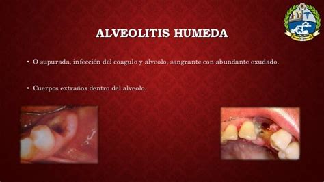 Alveolitis Humeda Pdf