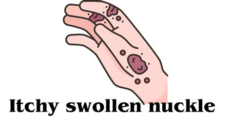 How To Treat Swollen Knuckles