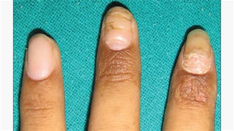 Horizontal Ridges On Thumb And Big Toe Nails Nail Ftempo