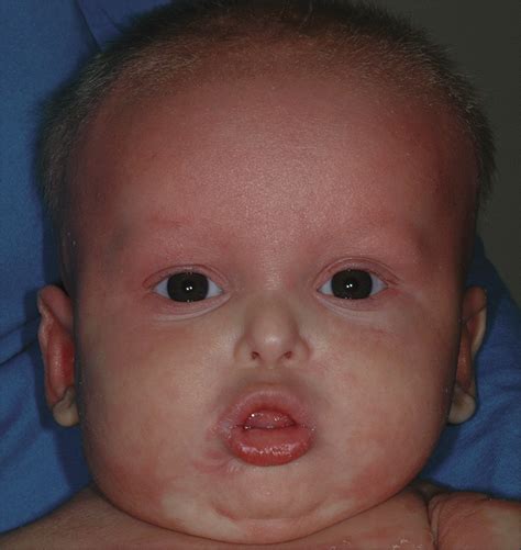 X Linked Ectodermal Dysplasia With Immunodeficiency Caused By Nemo
