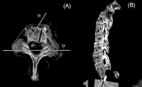 Axial A And Sagittal B Computed Tomography Reconstructions Angled