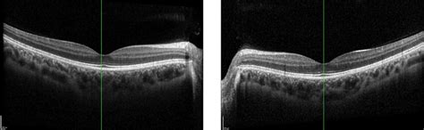 Lockdown And Eye Health A Case Of Accommodative Spasm Eye News