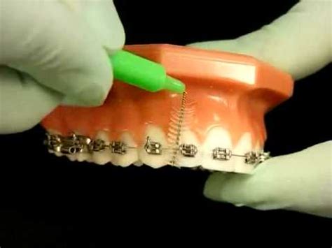 Tilt your toothbrush 45 degrees to clean the top and bottom of the braces. Bracesquestions.com - Brushing With Braces, How to Brush ...