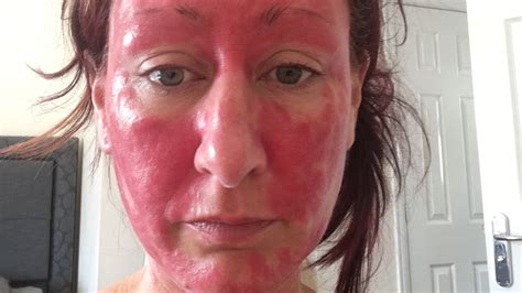 Woman Says Skins Addiction To Topical Steroids Made Psoriasis Even