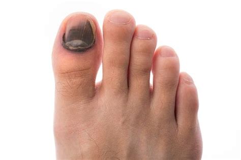 Cantengan merupakan infeksi bakteri yang terjadi pada bagian jempol kaki. Kuku hitam: Punca dan rawatan ⋆ Sihat.Net