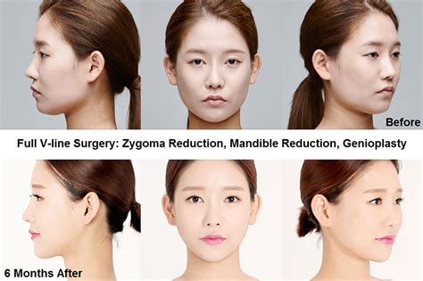 Most Popular Plastic Surgery Procedures In Korea Seoul Guide Medical
