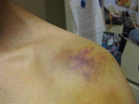 Bruised From “treatment” At The Institute Of Living Wagblog Dum