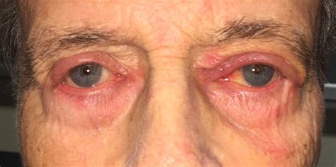 Periocular Periorbital Dermatitis Eyewiki