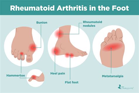 Rheumatoid Arthritis In The Feet Symptoms And Treatments