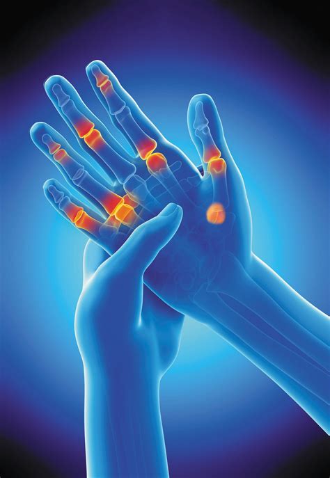 Arthritis Hand Pain