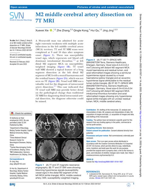 Pdf M Middle Cerebral Artery Dissection On T Mri