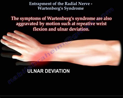 Entrapment Of Radial Nerve Wartenbergs Syndrome Everything You Need
