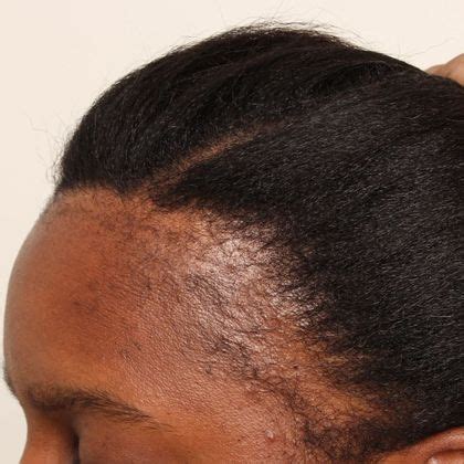 Check spelling or type a new query. Black female hair transplant - Female Before And After ...