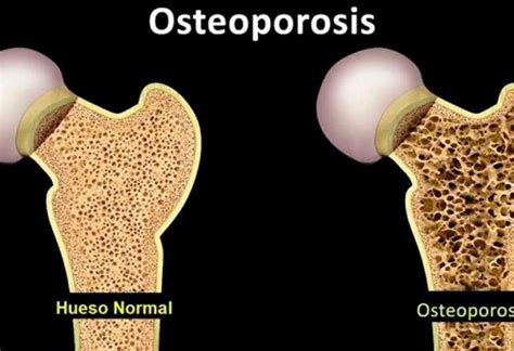 Hablamos Acerca De Fracturas De Cadera Por Osteoporosis Teletica