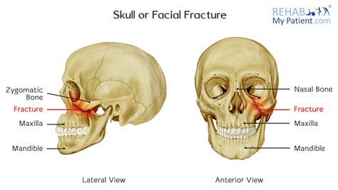 Skull Or Facial Fracture Rehab My Patient