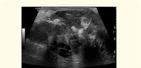 Ultrasound Image Of The Right Breast Retroareolar Area Showing A