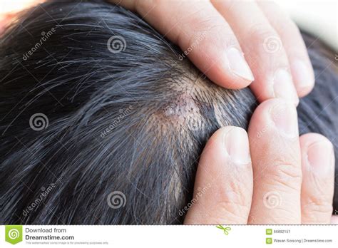 Comment l'identifier, comment la traiter ? Maladie De La Peau Sur La Tête Image stock - Image du ...