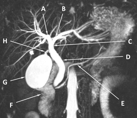 magnetic resonance cholangiopancreatography of the biliary tree and adjacent structures the bmj
