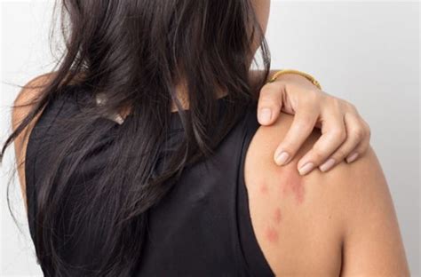 Stress Rash Tips For Identification Treatment And More