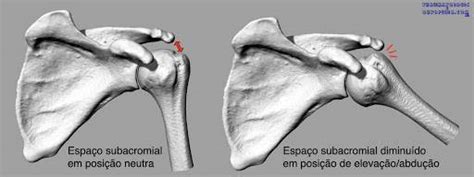 Síndrome Do Impacto No Ombro Traumatologia E Ortopedia