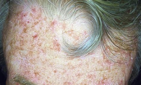 Skin Cancer From Sun Exposure