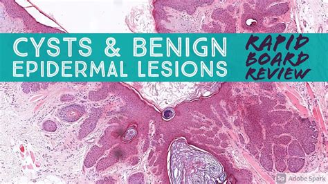 Rapid Board Review Cysts And Benign Epidermal Lesions Dermpath