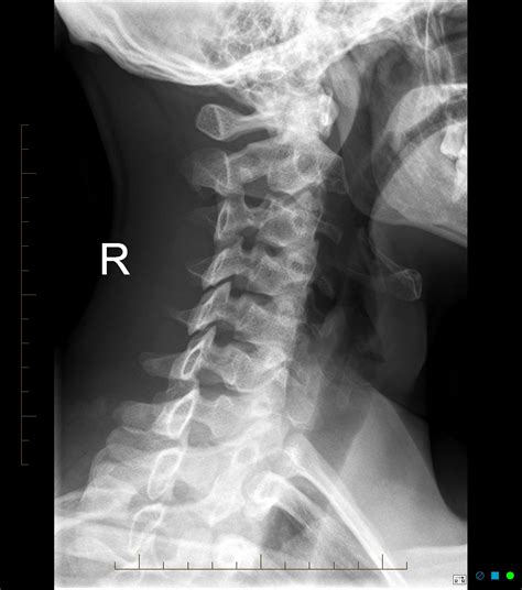 Normal Cervical Spine Radiographs Image