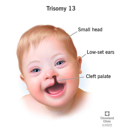 Trisomy 13 Patau Syndrome Pictures Hot Sex Picture