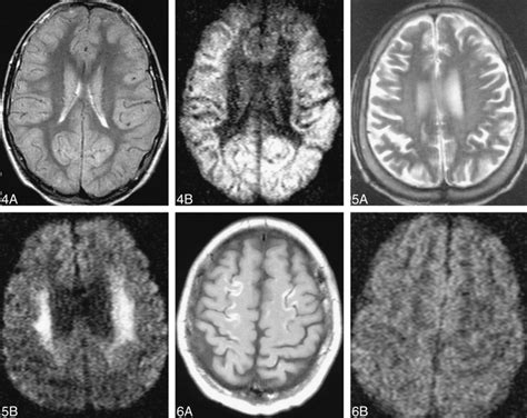 Diffusion Weighted Mr Imaging Ofglobal Cerebral Anoxia American