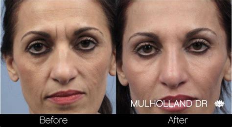 Before And After Photo Of Toronto Botox Patient Spamedica