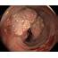 Colon Cancer Adenocarcinoma Endoscope View  Stock Image C038/4567
