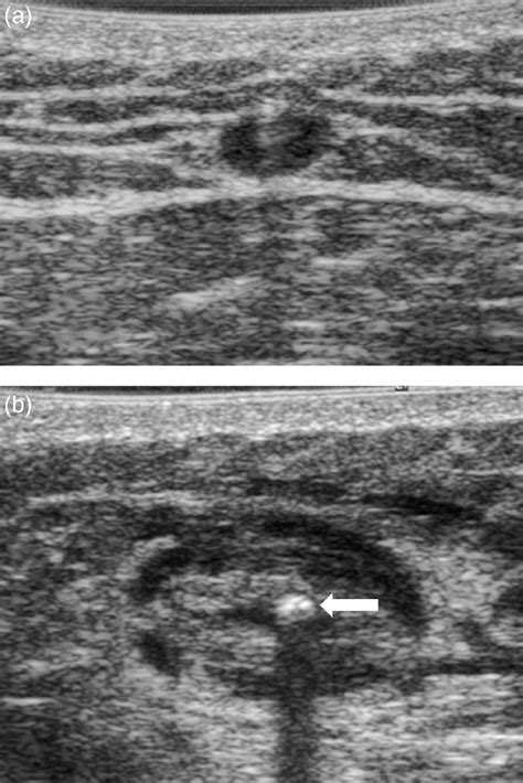 Transverse Sonographic Image Of The Great Saphenous Vein Within The