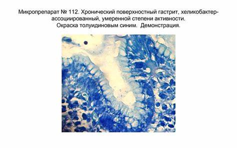 Хронический атрофический гастрит желудка диета Болезни желудка: гастрит, язвенная болезнь, опухоли желудка. Болезни желудка: гастрит, язвенная болезнь, опухоли желудка. Хронический атрофический гастрит желудка диета