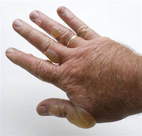 What Are The Most Common Causes Of Hand Blisters