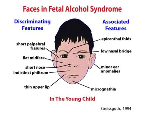 Interesting Fetal Alcohol Syndrome Fetal Alcohol Fetal Alcohol Spectrum Disorder