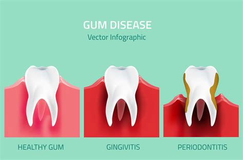 The Stages And Symptoms Of Gum Disease Described By Your General