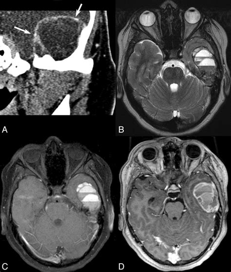 Ct And Mr Imaging Findings In A Patient With An Aneurysmal Bone Cyst