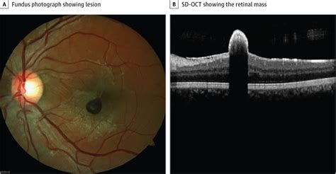 Dark Retinal Lesion In A Young Asymptomatic Man Congenital Defects