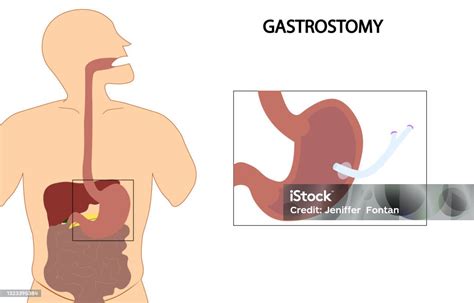 Gastrostomy Illustration Enteral Nutrition Feeding By Gastrostomy Tube