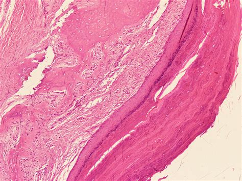 Pathology Outlines Epidermoid Inclusion Cyst