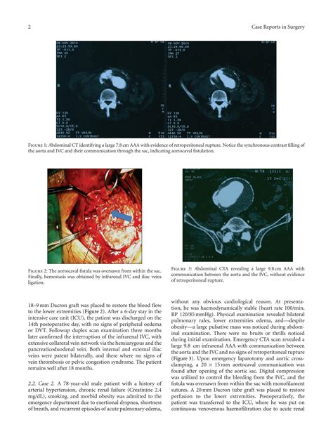 Solution Clinical Manifestations Of Aortocaval Fistulas In Ruptured