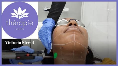 Thérapie Clinic Chin Laser Hair Removal On Black Skin Youtube